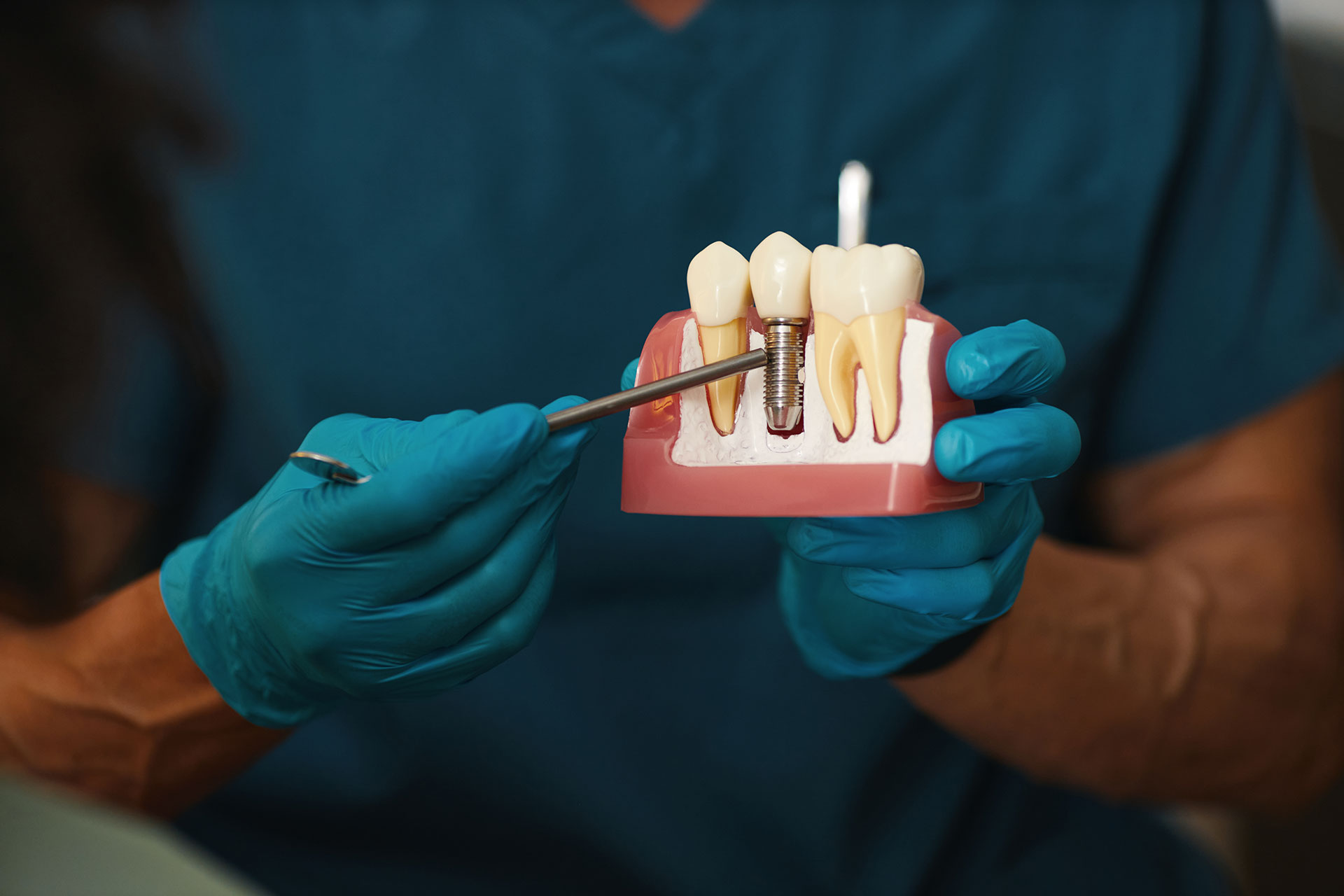 Por qué los implantes dentales fallan (y cómo evitar que te pase)